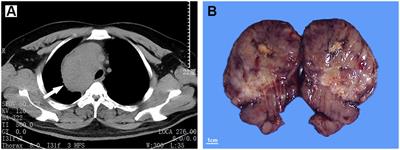 Case report: The stroma-rich variant of Castleman’s disease of hyaline-vascular type with atypical stromal cell proliferation and malignant potential: An exceptional rare case occurred in mediastinal lymph node